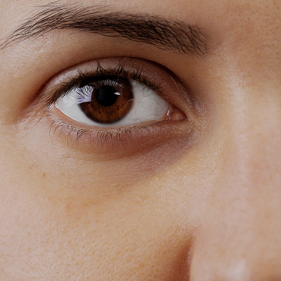 Cernes / poches sous les yeux