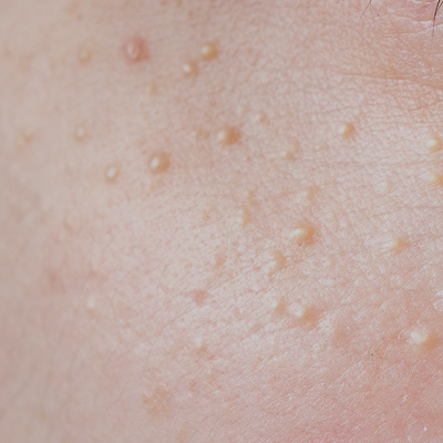Microkystes (points blancs)