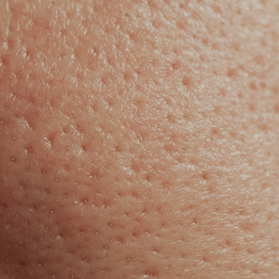 Pores dilatés